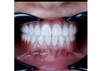 لابراتوار دندانسازی ساخت دندان مصنوعی ژله ای اگر هنوز دندان مصنوعی