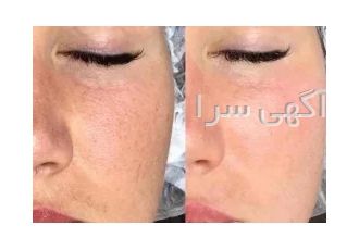 مزوژل و کلاژنسازی صورت گردن دورچشم و دست در تهران خیلی وقتها فکر می