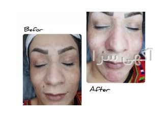 پاکسازی فیشال در قائم شهر پاکسازی پوست فیشال رفع آلودگی های پوست جوش