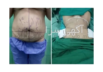 جراحی کوچک کردن شکم در تهران کلینیک جراحان زیبایی پارسی کلینیک تخصصی