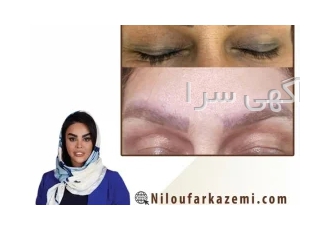 ریموو تاتو ابرو در یک جلسه در تهران خدمات ریموو تاتو ابرو در بهترین