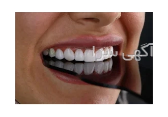 کامپوزیت و لمینت تخصصی دندان در کرج همیشه راهی برای داشتن لبخندی زیبا