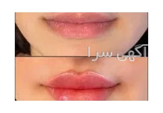 تزریق ژل توسط پزشک مجرب در اصفهان