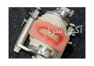 ساخت دندان مصنوعی باروش جدید همراه رفع لقی فک پایین