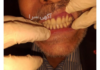 دندانسازی دندان مصنوعی فول دنچر پارسیل فوری ارزان دریا دندانساز حرفه ای