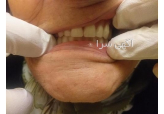 قالبگیری ساخت تعمیر ترمیم دندان مصنوعی در منزل قالبگیری و ساخت انواع