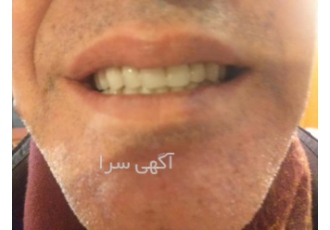تعمیر ترمیم لقی دست دندان ریلاین آستری سافت لاینر دریا