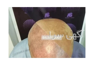 اسکالپ سر تاتو موی سر در کرج