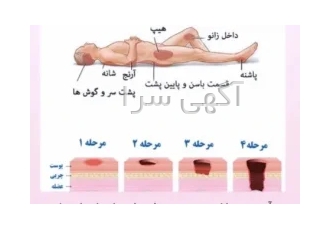زخم بستر چیست و چگونه بجود می اید ؟