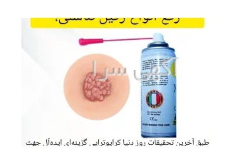 اسپری کرایوتراپی نیتروکسی درمان ۱۰۰ زگیل تناسلی در تهران چگونه تا 50٪