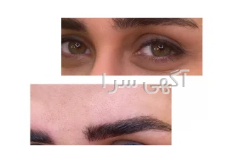 مدل رایگان جهت انجام فیبروز در تهران خیالتون از بابت نتیجه کار راحت