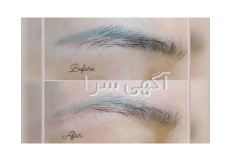 انجام ریموو تتوی ابرو لب و خط چشم وتتوی بدن در تهران انجام خدمات ریمو