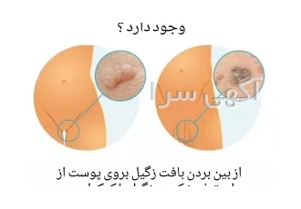 آیا امکان درمان زگیل تناسلی در خانه وجود دارد؟