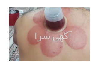 آموزش حجامت با مدرک دانشگاهی