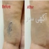 کلینیک درمانی واریس در تهران درمان قطعی واریس در کلینیک واریس ✴️ روش