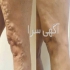 کلینیک درمانی واریس در تهران درمان قطعی واریس در کلینیک واریس ✴️ روش