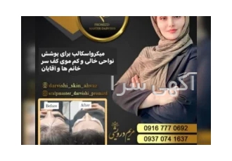 میکرواسکالپ سر