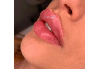 تزریق ژل لب گونه چانه و اصلاح فرم فک درمان خط خنده