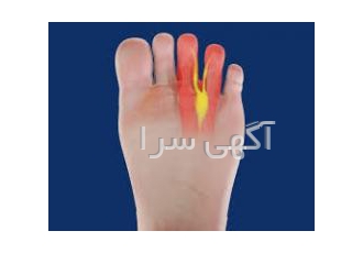 درد کف جلوی پا (مورتون نوروما ) - اهواز