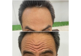 بوتاکس دیسپورت تزریق بوتاکس درمان چین و چروک صورت درمان چین و چروک صورت