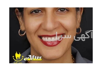 کامپوزیت ونیر در تهران یکی از روش های اصلاح طراحی لبخند کامپوزیت ونیر