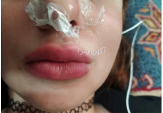 آموزش و تزریق ژل و بوتاکس به صورت حرفه ای
