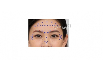 انجام بوتاکس دور چشم - مناسب ترین قیمت بوتاکس