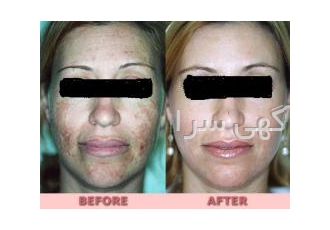 دستگاه میکرودرم پاک کننده پوست و رفع کننده لک و چروک دستگاه میکرودرم