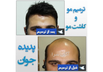 مشاوره رایگان (ترمیم مو پدیده جوان)