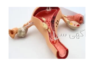 درمان افتادگی رحم در ساری / دکتر هدی حق نظر افتادگی رحم یکی از مشکلات