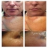دستگاه پلاژن سه بازو Pollogen Super Facial ۳in۱ در تهران دستگاه پلاژن