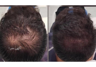 مرکز تخصصی میکرواسکالپ مژده پورسلطانی در رشت