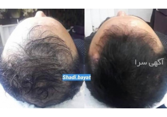اسکالپ میکروپیگمنتیشن اسکالپ اسکالپ سر برای اولین بار در اصفهان