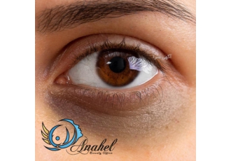 رفع تیرگی و گودی زیر چشم به صورت تخصصی ✅مجموعه زیبایی و درمانی آناهل ✅