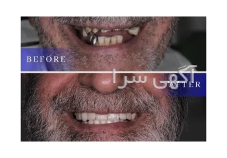 مرکز ایمپلنت تهران کاشت دندان با بهترین قیمت و شرایط اقساطی مرکز