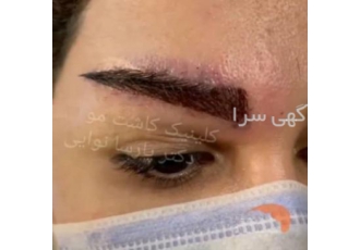 کاشت مو و ابرو دکتر نوایی اصفهان