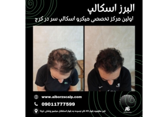 اسکالپ سر در کرج میکرو اسکالپ در کرج اولین مرکز میکرو