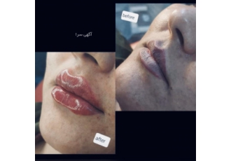 تزریق فیلر لب روسی