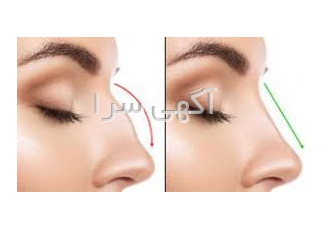 عمل بینی جراحی زیبایی بینی | فرم دهی بینی جراحی زیبایی بینی با بهترین