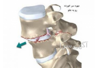درمان سلولی دیسک کمر و گردن با لیزر سلولی در غرب تهران درمان سلولی دیسک