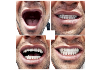 دندانسازی پارسیل((متخصص درساخت انواع دندان)) تنها دندانسازی متخصص