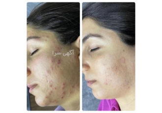 فیشیال تخصصی پوستهای چرب، خشک و مختلط