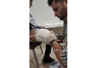 ساخت پروتز پیشرفته