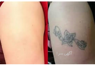 فروش انواع دستگاه لیزر حذف تتو و مو های زائد با گارانتی در مشهد فروش