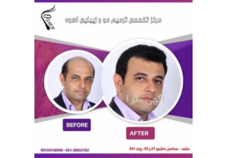 مرکز پخش و فروش پروتز مو و کلاه گیس طبیعی – ترمیم مو ا