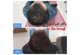پی آرپی موی سر و رویش مجدد پلاکت سلول ترمیم کننده بدن ماست که در ترمیم