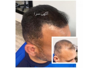 پرپشتی مو در یک جلسه با اسکالپ سر اسکالپ سر امروزه کم پشتی موها بین