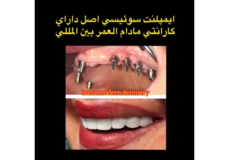 ایمپلنت دندان