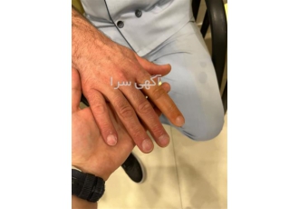 ساخت پروتز دست مصنوعی انواع اسپیلنت پروتز زیبایی در طالقان ساخت