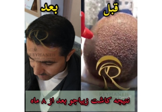 کاشت مو و ابرو کاشت مو و ابرو آقایان و بانوان توسط بهترین تیم کاشت